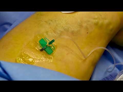 Varithena - Varicose Vein Removal