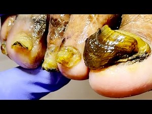 Onychomycosis Is Very Hard, Perfect Trimming Process【Dr. Liu's Pedicur】