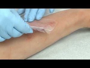 Mepitel® One - Anwendungsvideo - Mölnlycke Health Care