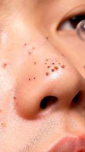 115K views · 401 reactions | Deep blackheads extraction #blackheadremoval #satisfying #PimplePopping #usa uk | Purepore Asmr | Facebook