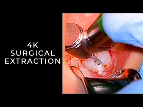 Surgical Extraction | 4K Learning | OnlineExodontia.com