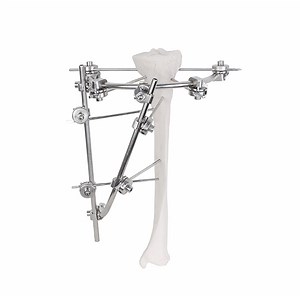 [Hot Item] Femoral External Fixator Set for Fractures Orthopedic Surgical Instruments