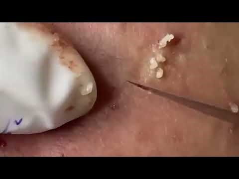 Whitehead Removal & Acne Treatments | Clear Skin Tips ‪@removeblackhead‬