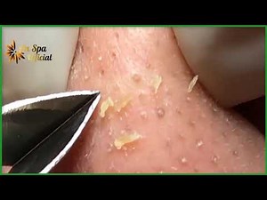 Best Satisfying Nose Plucking Blackheads Whiteheads Removal | Acne Treatment #44