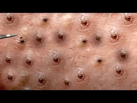 Amazing Blackheads Remover on the Face #007