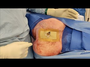 Pelvic Osseointegration for Patients with Hip Disarticulation