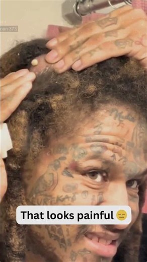 Deep Blackheads, Milia & Whitehead Removal pimple popping New| Big Cystic Acne Extraction #1157 2026