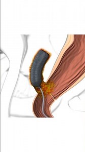 Endo-SPONGE Connection to Pump and Removal: Step-by-Step Guide | Boston Scientific