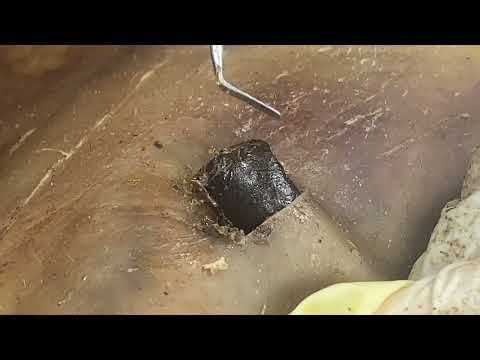 DR LEE’S TLC dr. pimple popper blackheads satisfying cyst removal HQ1309M30313
