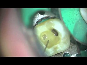 partial pulpotomy #02