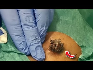 15 YEAR OLD BLACKHEAD GETS POPPED! 😱 | Massive 15 year Blackhead Dr Khaled Sadek