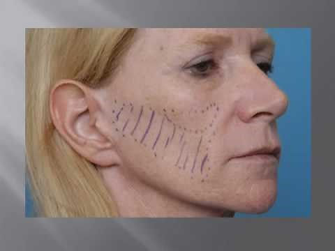 Submalar Implants and Fat Injections in Facial Lipoatrophy with Dr. Barry Eppley