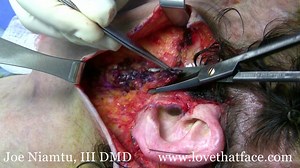 Earlobe Repair Techniques (Torn Lobes, Gauged Lobes, Lobe reduction)