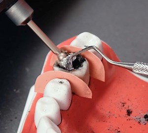 1.4M views · 4.8K reactions | Watch how dentists work on restoration of a rotten molar tooth! | 5-Minute Crafts Family | Facebook
