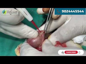 Laser Frenuloplasty in Jaipur | Fast & Painless | Dr. Deepesh Goyal