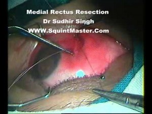 Medial Rectus Resection: Muscle Reattachment(Squint Surgery)By Dr Sudhir Singh #28