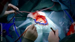 close-up of the operation of craniotomy, the opening of the brain for removal of tumors in the temporal lobe. surgeon modern tool drills the skull