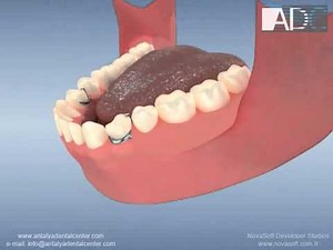 Metal partial denture in lower jaw