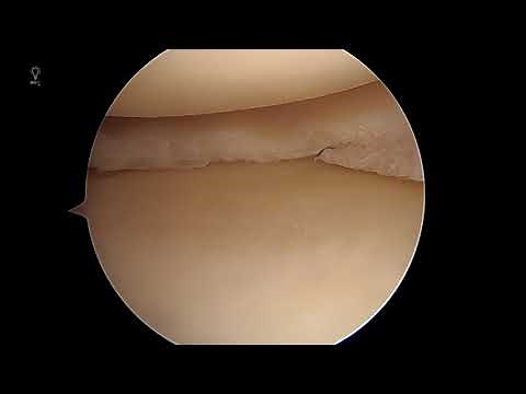 Knee Arthroscopy - Partial Medial Meniscectomy - Dr. Andrew Dold, MD