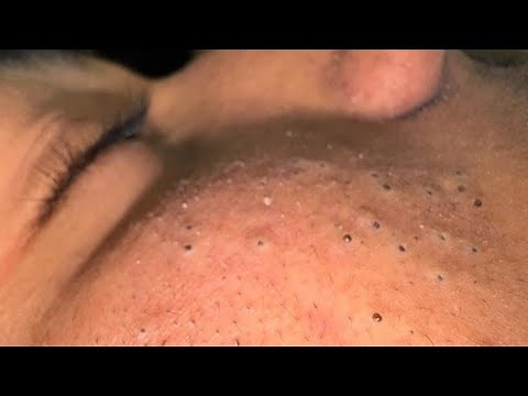 Say Goodbye to Whiteheads in 3 Simple Steps!