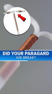 ⚖️ Thousands of women are taking action about the Paragard IUD. If yours broke during removal, you may be owed compensation. ✅ Connect with a case specialist 📞 for a free, confidential review today. | Paragard Lawsuit Claim Help