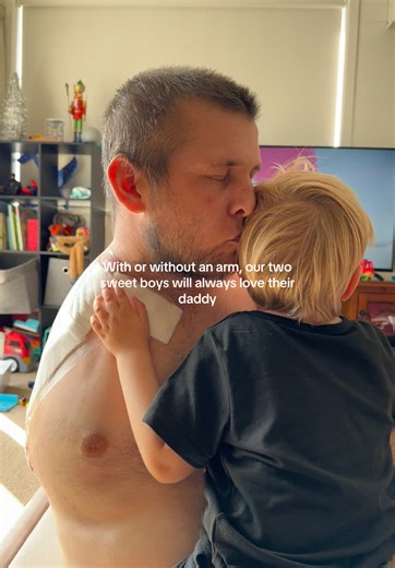 Life After Amputation Surgery: A Journey of Resilience and Love