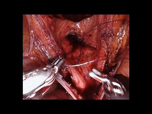 Robotic simple prostatectomy - The Basics