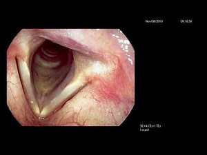 Adductor Spasmodic Dysphonia Causing Disturbance of Speech