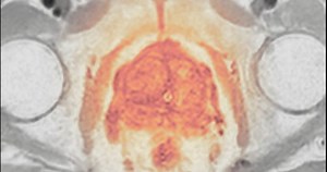 clip-3843390799-mri-scan-reveals-enlarged-prostate-gland-possible