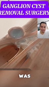 Ganglion cyst removal surgery #followers | Dexter Sabado