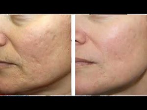 Micro Botox for Facial Rejuvenation | Face Lift | Kayakalp Laser Clinic