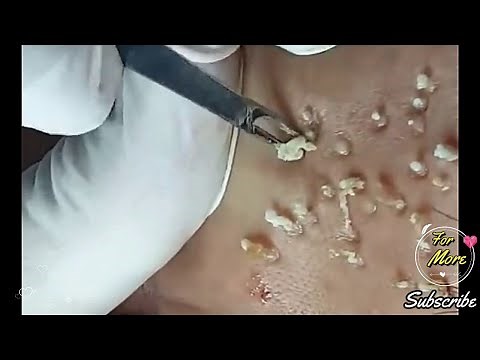 Blackheads & whiteheads being removed and treatment 2020