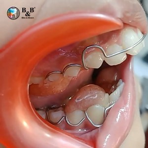 65K views · 4 comments | By• @bites.braces CLASS II MALOCCLUSIONS...