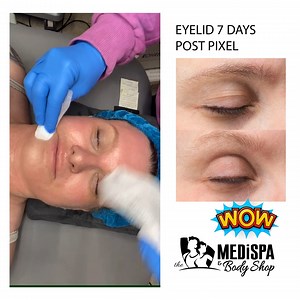 Heather gets a Pixel8-RF for skin rejuvenation on the face and neck. But what’s even more great is that we can do the eye area with this treatment. See below for what to expect post treatment and we’ll continue to post results. This is an amazing way to restore youthful skin without surgery or downtime. | MediSpa & Body Shop