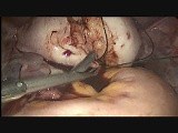 8.6 x 7 cm Fundal Wall Highly Vascular Fibroid with Disturbing Cavity • Video • MEDtube.net