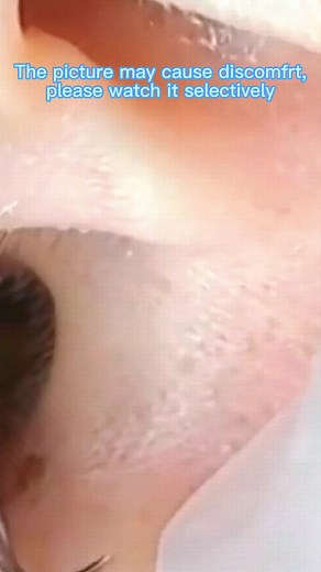 #pimplepop #acnetreatment #acne #pimplepopper #pimplepopper2021 #pimplepopper2022 #satisfyingvideo #cystpopping #pimple #skincare #fyp #removal #tiktok