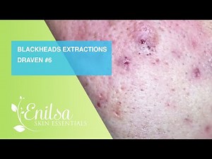 Blackheads Extractions Draven 6th Treatment