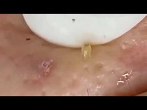 #34~Blackheads•Blackheads On Nose • Blackhead 2021 New Videos • New 2021 Blackhead Extraction Videos