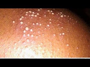 Popping Melissa's Staph Infected Cyst - Pimple Popping
