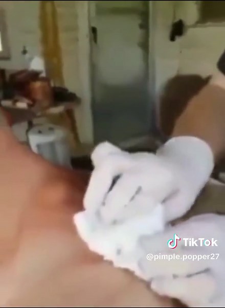 Giant Back Pimple Extraction - Satisfying Blackhead Removal Video