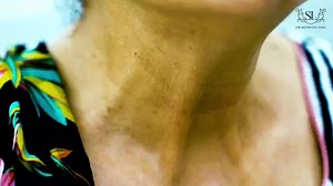 23K views · 418 reactions | Platysma bands are the vertical cords that appear in the neck as one of the first signs of aging especially in females. BOTOX is a nonsurgical option that can be used to treat platysma bands. #neckbands #DrShaistaLodhi #theaestheticsclinic | The Aesthetics Clinic | Facebook