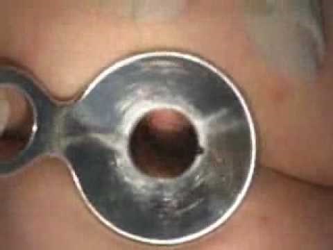 Anoscopy (sample) - www.proceduresconsult.com