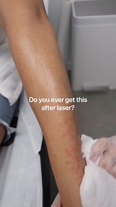 Did you develop tiny bumps following your laser hair removal appointment? 🤷🏻‍♀️ This is completely normal!🙋🏻‍♀️ Follicular edema results in swelling of the hair follicles, and it can be distressing to experience for the first time. 🫵🏻 The good news? It's quite normal and not a cause for concern. ✌🏻 Tips to help: 🎯 Apply cold compress 🎯 Avoid heat exposure 🎯 Protect from sunlight 🎯 Wear loose clothing 🎯 Apply aloe vera to reduce redness | Epta Clinic