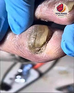 2.2K views · 12 reactions | Effective Care Strategies for Brittle Toenails As Part of Holistic Wellness #SafeSteps #WellnessSeniors #FootCareTips | Tots Mags Wheel | Facebook