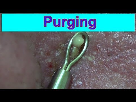 Purging | Life With Cystic Acne Documentary #42