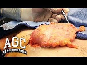 Massive Unilateral Gynecomastia Removal - Male Breast Asymmetry - Gyno On One Side