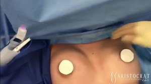 3 Months Post Periareolar Mastopexy Breast Lift Augmentation with Silicone Implants by Dr. Kevin Tehrani
