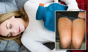 SHOCKING skin condition from over using hot water bottle