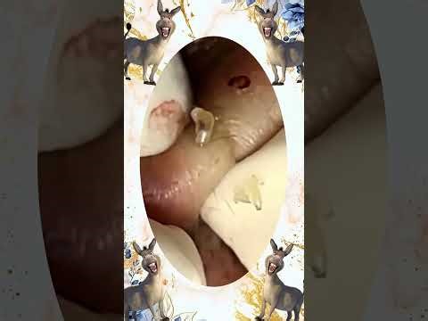 Blackheads Removal #350 | Acne Treatment and Very Satisfying Satisfying Pimple pop #blackheads