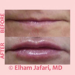 👁 Lip augmentation and enhancement 👄 _____________________ 💉 Procedure: Dermal filler injection in lips by experienced MD _____________________ 🎯 Purpose: Adding volume to the lips to create pouty and better-defined lips with a balanced and natural appearance without surgery and down-time _____________________ 💊 Products used: Typically Juvederm, Voluma, Restylane Lyft (Perlane), Restylane Kysse or Volbella _____________________ 🌹 Results: Results appear immediately but may take up to 2 we